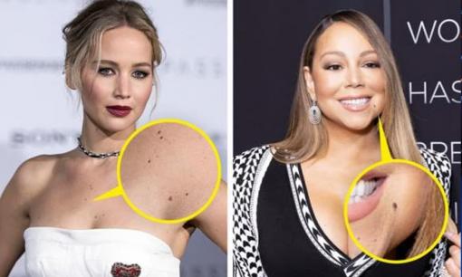 Nốt ruồi đến từ đâu và tại sao việc phân biệt chúng lại quan trọng như vậy