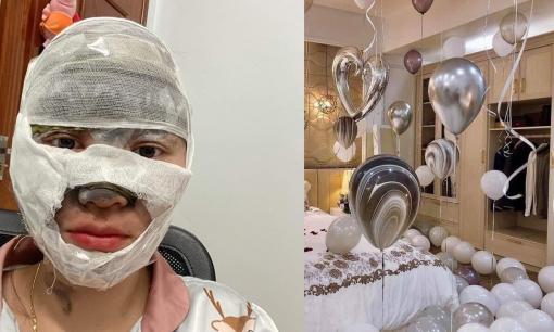 Dùng bơm điện bơm bóng bay, cô gái bị nổ bỏng mặt