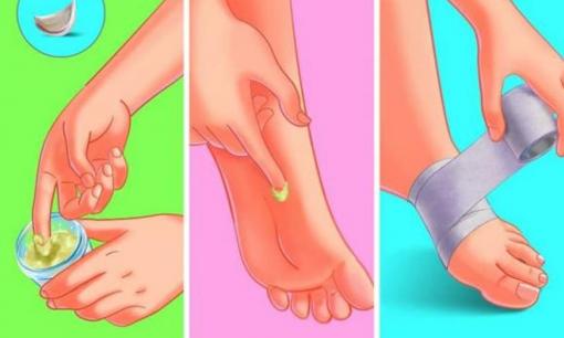 Cách loại bỏ mụn cóc ở bàn chân: 5 Cách