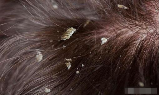 Tại sao tôi bị gàu? Hay liên quan đến 5 nguyên nhân cần cải thiện kịp thời