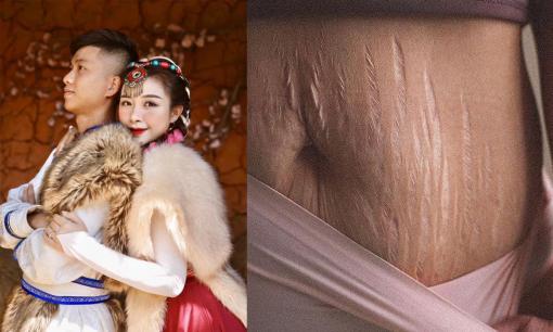 Bà xã Phan Văn Đức đăng ảnh da bụng bị rạn sau sinh, tiết lộ luôn phản ứng của chồng khi xin đi nâng ngực