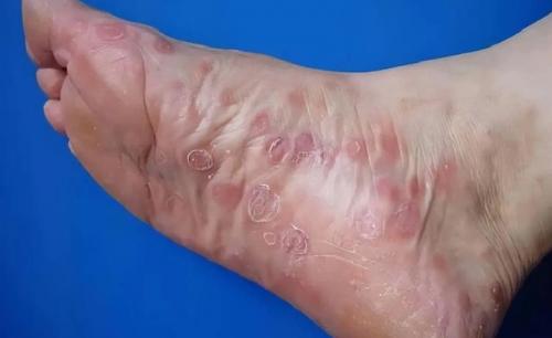 Bệnh giang mai thích chơi trò 'tiềm ẩn', nếu cơ thể có 5 thay đổi này thì nên đến bệnh viện khám