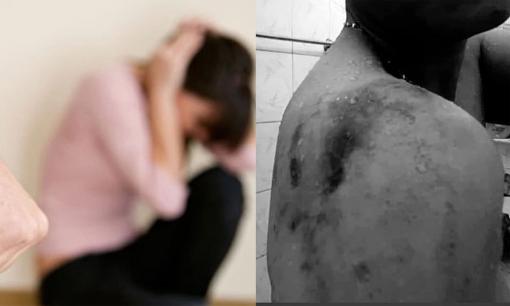 Ám ảnh với câu chuyện người vợ kể bị chồng đánh bầm dập, lấy đầu thuốc lá đang cháy dí vào người