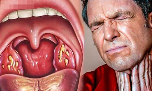 Cách trị dứt điểm viêm họng trong 4 giờ cực đơn giản mà hiệu quả cao 