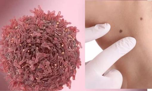 Nhắc lại: Nốt ruồi mọc ở 3 bộ phận hay “liên quan mật thiết” đến ung thư cần xử lý càng sớm càng tốt