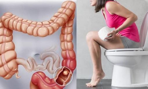 Có 4 hiện tượng trong cơ thể, có thể do 'ung thư đường ruột', tốt nhất nên đến bệnh viện kiểm tra