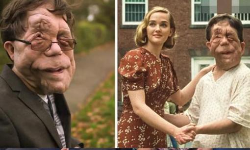 Câu chuyện về Adam Pearson dù mắc một căn bệnh hiếm gặp, vẫn được hàng triệu người biết đến và truyền cảm hứng cho những người khác bằng nghệ thuật của mình 