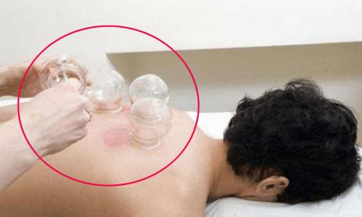 Trong lúc giác hơi, vết thâm hút ra từ lưng có thực sự là độc tố? Bác sĩ đã nói với bạn sự thật