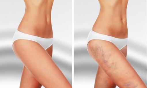 7 yếu tố có thể gây ra vết bầm tím đáng lưu ý