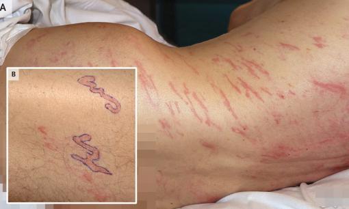 Người đàn ông Tây Ban Nha đến bệnh viện với căn bệnh cực hiếm: Bác sĩ tìm thấy giun sống dưới da 