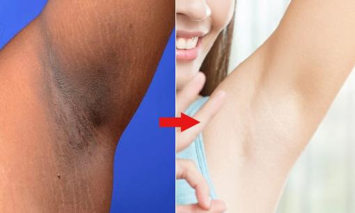 Đánh bay vết thâm trên da nhờ 4 phương pháp đơn giản mà không hề tốn tiền