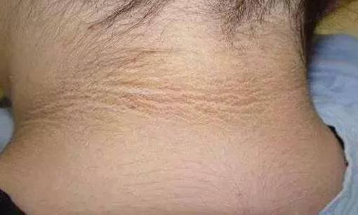 Ung thư nội tạng, nhà tiên tri da! Nếu cơ thể xuất hiện những triệu chứng này, chúng ta phải hết sức lưu ý! 