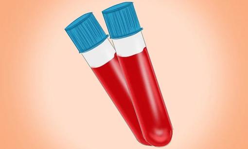 Khi mỡ máu tăng cao, cơ thể sẽ xuất hiện hai triệu chứng này, thường xuyên ăn hai loại thực phẩm, hạ mỡ máu! 