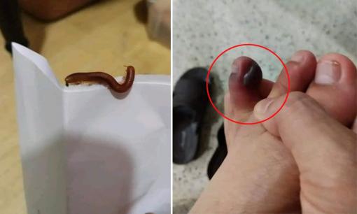 Khinh thường con cuốn chiếu, cô gái bị 'cắn' hoại tử ngón chân, gửi lời cảnh báo tới mọi người