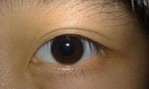 Trong người có ung thư, đôi mắt là 'tiên tri', nếu mắt xuất hiện 3 thay đổi này hãy đến bệnh viện khám càng sớm càng tốt