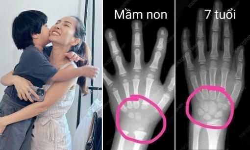 Nhìn hình ảnh chụp X-quang bàn tay của trẻ mầm non và 7 tuổi, vợ Hoàng Bách lên tiếng cảnh báo phụ huynh muốn cho con viết sớm