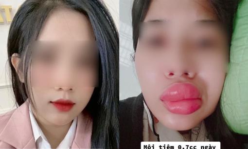 Muốn tiêm môi cho xinh hơn, ai ngờ cô gái gặp cái kết 'đắng'