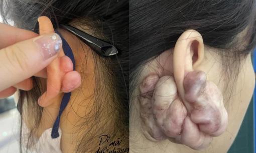 Cô gái gặp biến chứng 'khủng khiếp' vì xỏ khuyên tai, ai nấy lập tức bỏ ý định khi chứng kiến cảnh này
