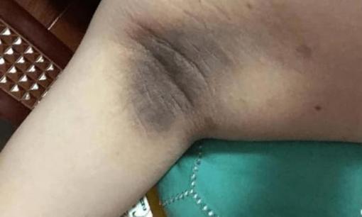 Có ung thư trong cơ thể, nhà tiên tri da? 5 bộ phận này trên cơ thể chuyển sang màu đen, ung thư gõ cửa