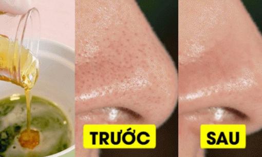 Lỗ chân lông dễ dàng trở nên se khít nhờ 4 mẹo đơn giản, chẳng cần tốn tiền đi spa lăn kim siêu vi điểm