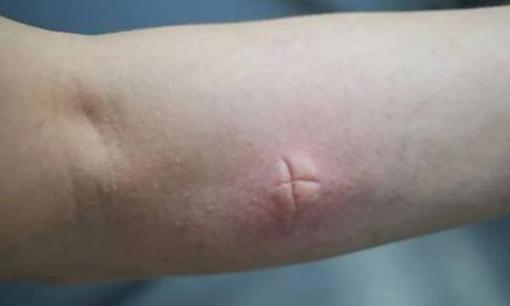 Phương pháp giảm ngứa tức thì sau khi bị muỗi đốt, tiếc là không biết sớm hơn 