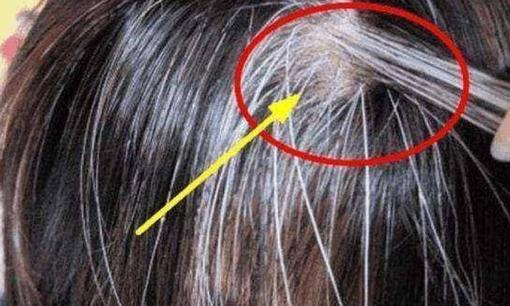 Cơ thể thiếu vitamin gì khiến tóc bạc? Làm thế nào để ngăn tóc bạc xuất hiện? Tôi sẽ hiểu sau khi đọc nó