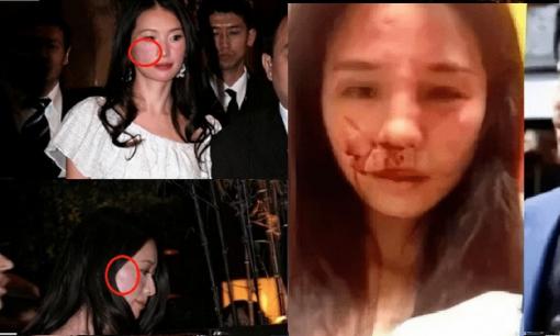 Ảnh Lâm Chí Linh trong bệnh viện, mặt bầm tím và mũi bị vẹo vì bị người chồng bạo hành sau khi vợ phát hiện anh qua lại với 3 cô gái?