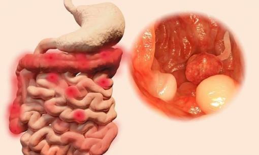 Có polyp trong ruột, khi đi vệ sinh sẽ có 2 tín hiệu, đừng đợi đến giai đoạn muộn mới phản ứng