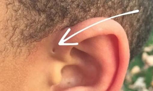Có một lỗ nhỏ bên cạnh ống tai, đó là lỗ gì? Đặc điểm này liệu có bất thường?