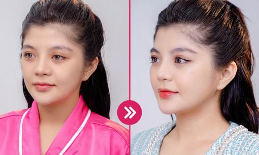 Nâng mũi bằng sụn tai là gì? Địa chỉ nâng mũi uy tín