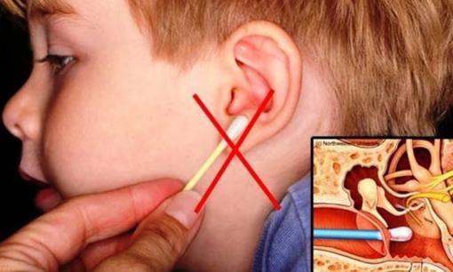 Cách chuẩn nhất và nhanh nhất để lấy ráy tai theo khoa học, tuyệt đối không dùng tăm bông 