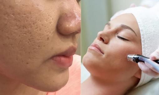 Nhiều spa quảng cáo trị sẹo chỉ trong một lần điều trị duy nhất, bạn có tin được không?