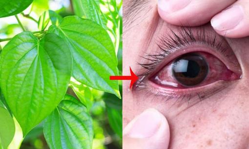 Chữa đau mắt đỏ bằng lá trầu không có thực sự hiệu quả? Những sai lầm khiến bệnh đau mắt đỏ càng thêm nặng