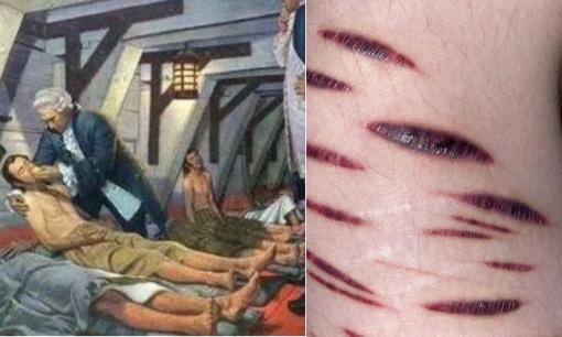 Tại sao bệnh scorbut là cơn ác mộng trong lịch sử hàng hải phương Tây?