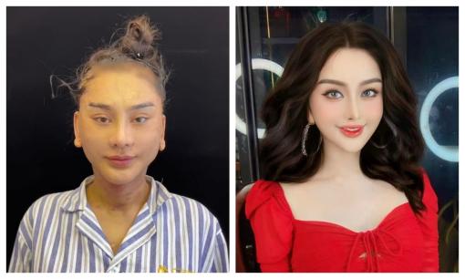 Lộ ảnh 'khác lạ' của Lâm Khánh Chi khi sang Trung Quốc căng da mặt để trẻ hóa, duy trì thanh xuân