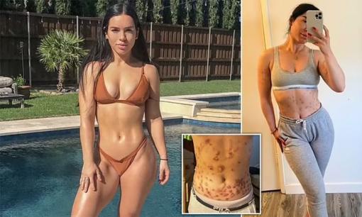 Nỗi kinh hoàng của người phụ nữ đam mê thể hình, cơ thể 'thối rữa' sau khi tiêm 60 liều vitamin giảm béo