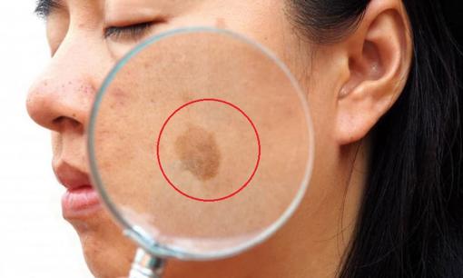Tại sao khuôn mặt một số người lại đầy 'đốm đồi mồi' trong khi những người khác lại sạch sẽ? Cuối cùng bác sĩ đã nói ra sự thật