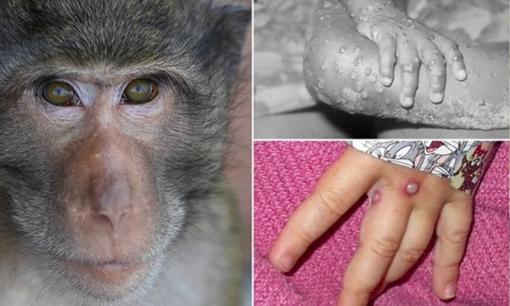 Việt Nam đã ghi nhận 56 ca đậu mùa khỉ, cách để nhận biết triệu chứng và phòng tránh