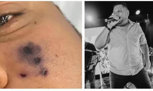 Nam ca sĩ 28 tuổi qua đời 6 ngày sau khi bị nhện cắn tại nhà, gia đình tiết lộ: 'Đột nhiên mặt anh chuyển sang màu đen' 