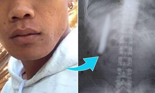 Câu chuyện hy hữu: Một con dao mắc kẹt trong ngực người đàn ông hơn một năm mà không hề hay biết 