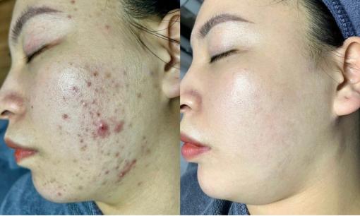 Chăm sóc da mụn tuổi dậy thì đúng cách