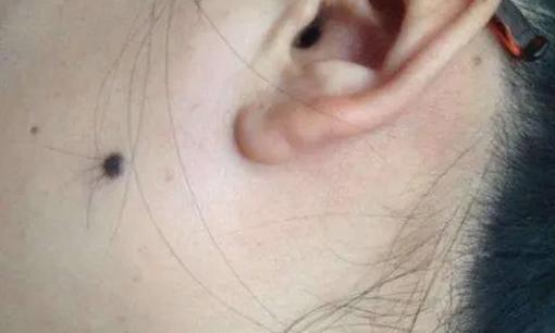 Nốt ruồi lông là tốt hay xấu về mặt tướng số? Có nên nhổ lông trên nốt ruồi không?