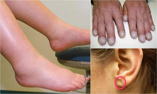 3 dấu hiệu trên da cảnh báo bệnh tim, những ngày trời lạnh càng phải chú ý