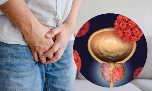 Đi tiểu nhiều, tiểu gấp có phải là bệnh tuyến tiền liệt? Bệnh tuyến tiền liệt có chuyển thành ung thư tuyến tiền liệt? 