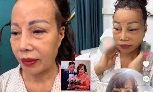 'Cô dâu U70' Thu Sao lộ ảnh phẫu thuật căng da mặt, thái độ của chồng trẻ càng gây chú ý