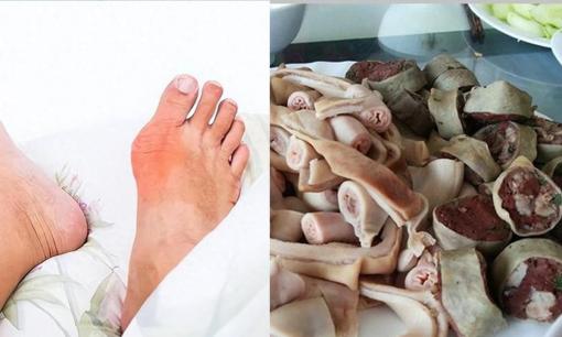 Nhắc nhở: Để tránh tăng acid uric, hãy cố gắng tránh xa 3 thứ