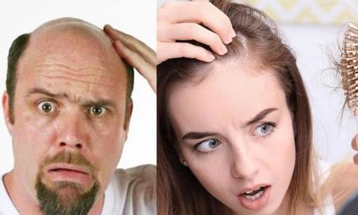 Đàn ông thường hói đầu còn phụ nữ thì hiếm khi, lý do hóa ra liên quan đến điểm này 