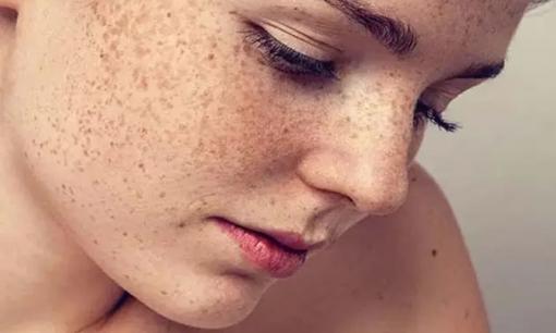 Tại sao khuôn mặt của một số người đầy đốm đồi mồi trong khi những người khác lại sạch sẽ? Bác sĩ nói sự thật 