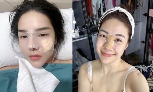 Chuyện làm đẹp mũi của sao Việt: Kỳ Hân bị chê; Pha Lê chịu 'đau tới não' khi tháo sụn vì bị viêm 