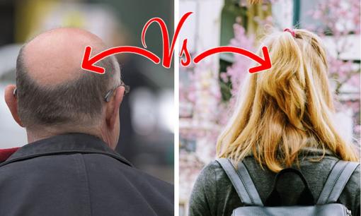 Đàn ông thường hói đầu còn phụ nữ thì hiếm khi, lý do hóa ra liên quan đến điểm này, bạn có bị không?